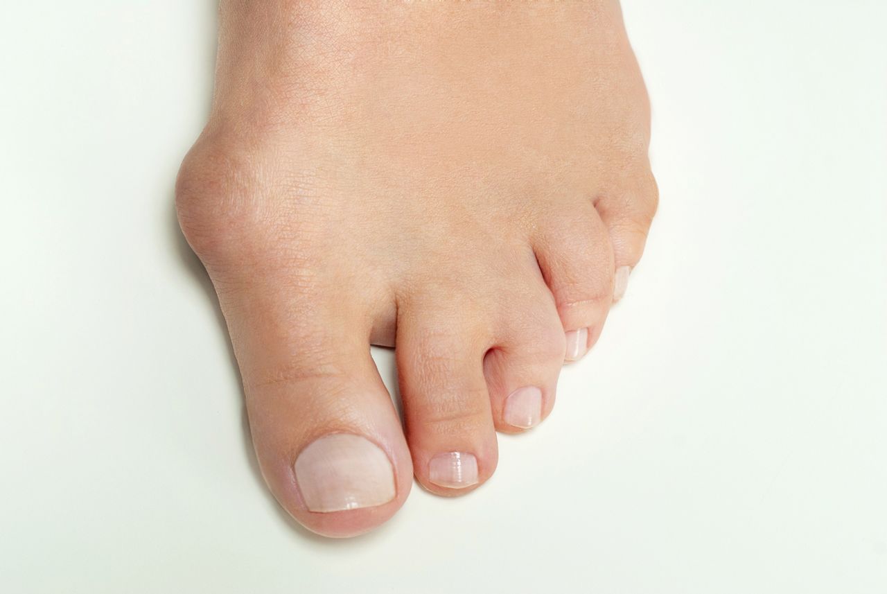 A close up of a person 's foot with a bunion.
