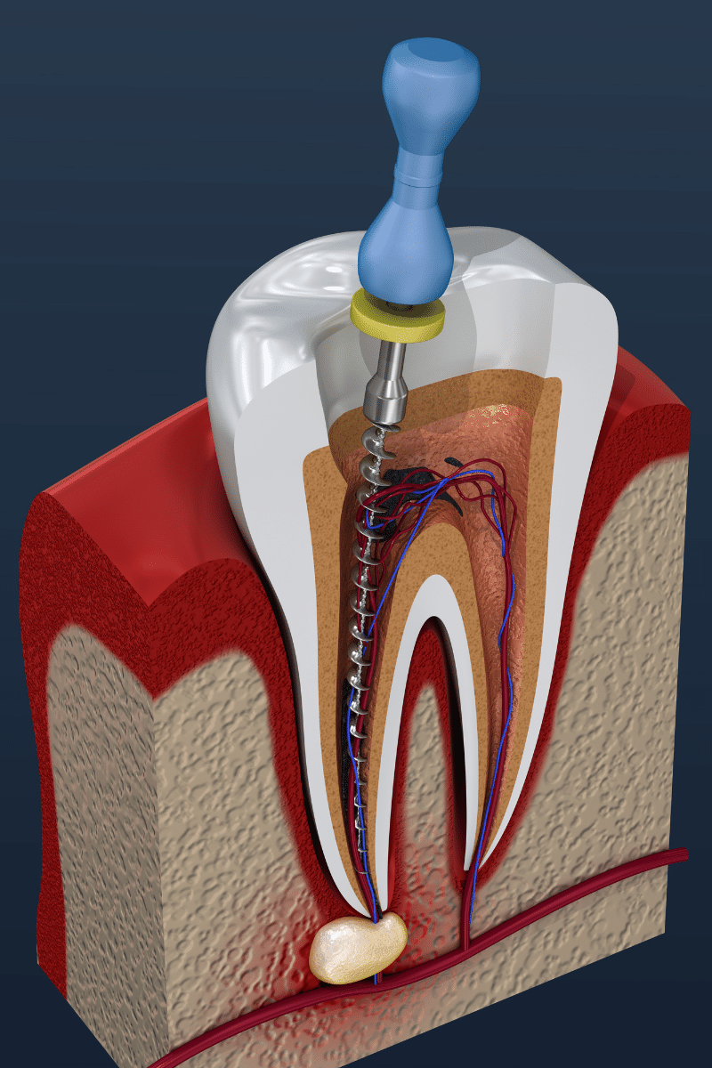 root canal retreatment at kipnis dental clinic in brooklyn ny