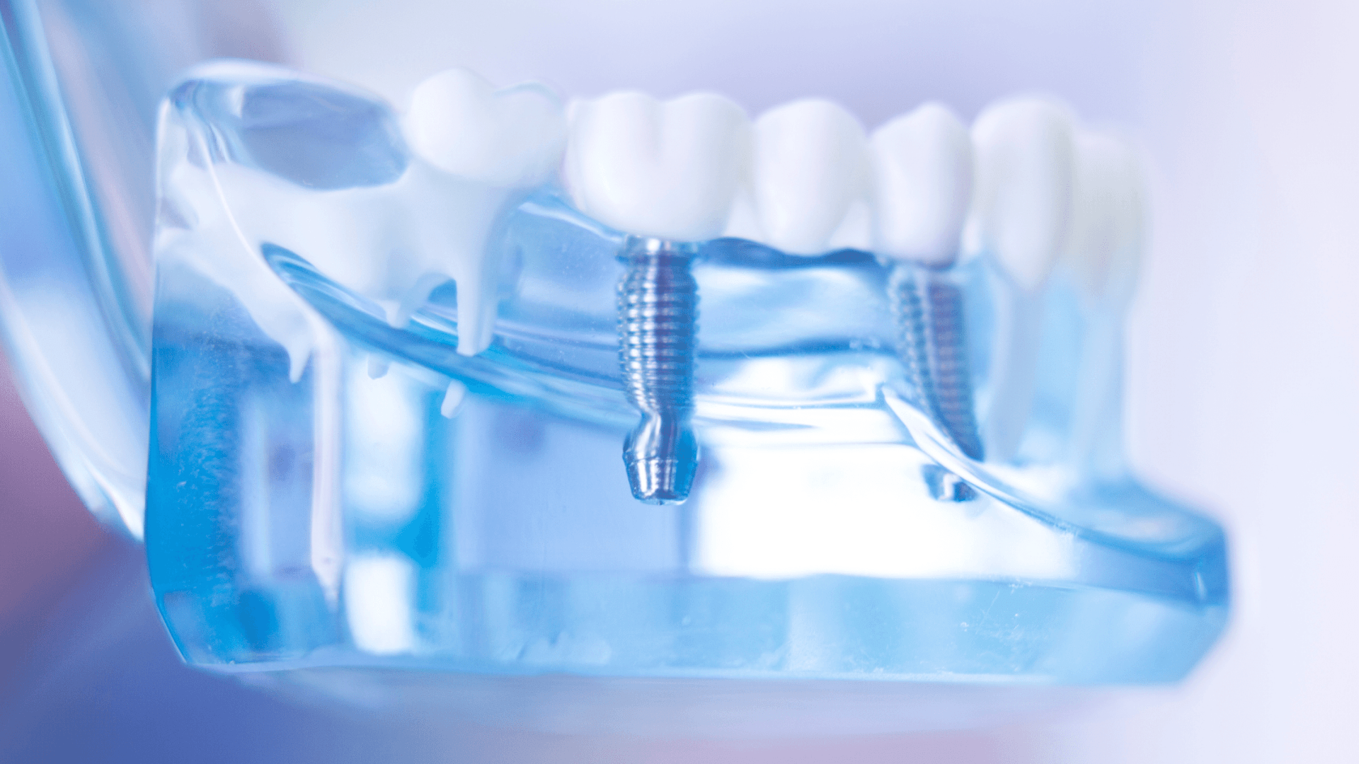 different types of dental implants: all-on-4 all on 4 brooklyn