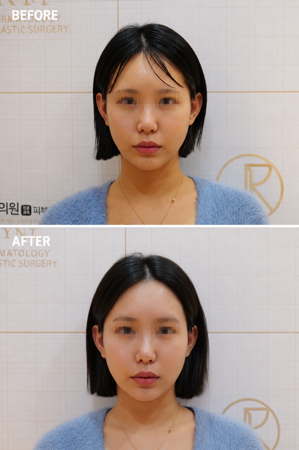 下颌轮廓与提升 — 术前术后,JRYN皮肤科 釜山西面