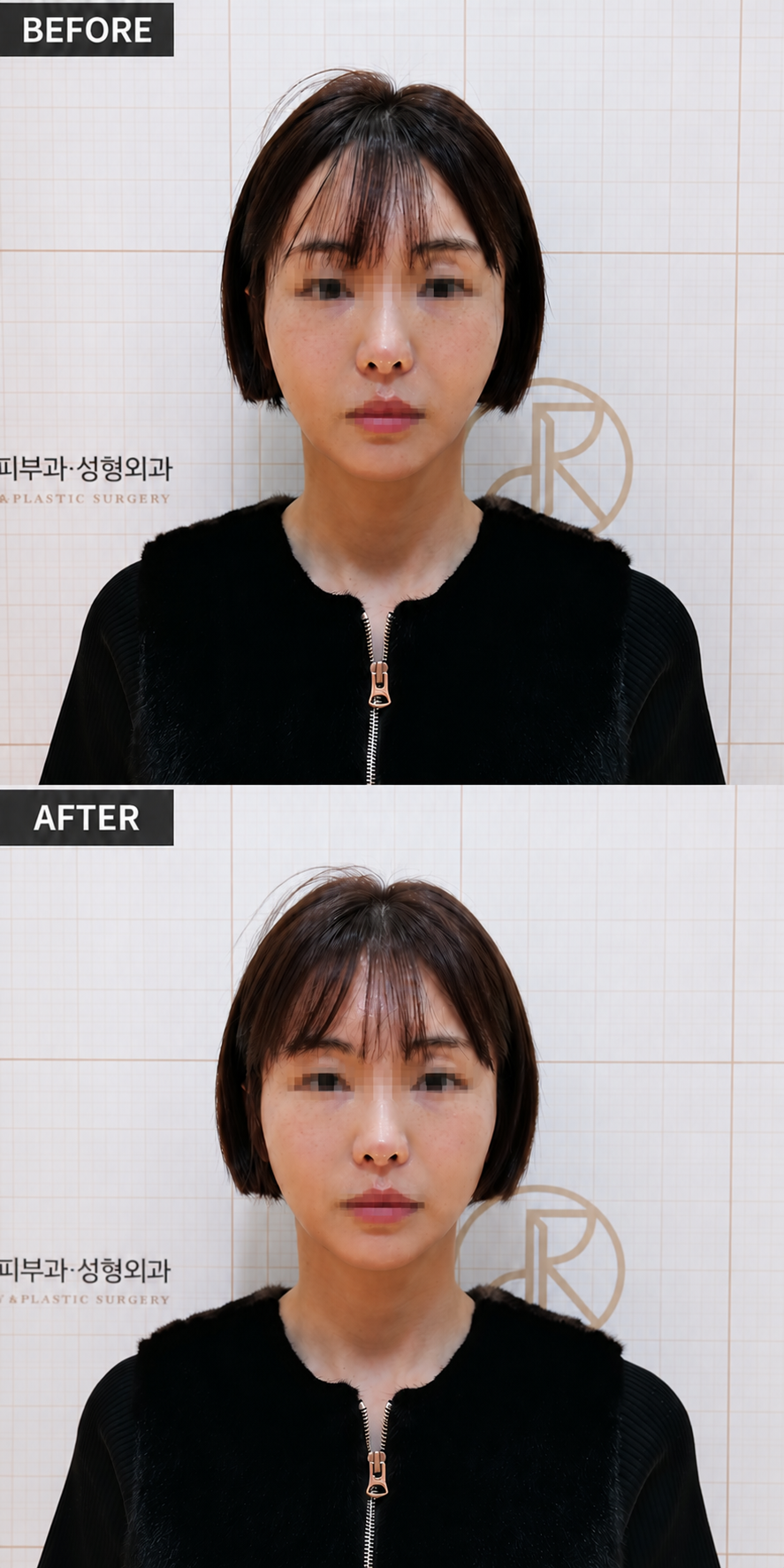 提亮与肤质 — 术前术后,JRYN皮肤科 釜山西面