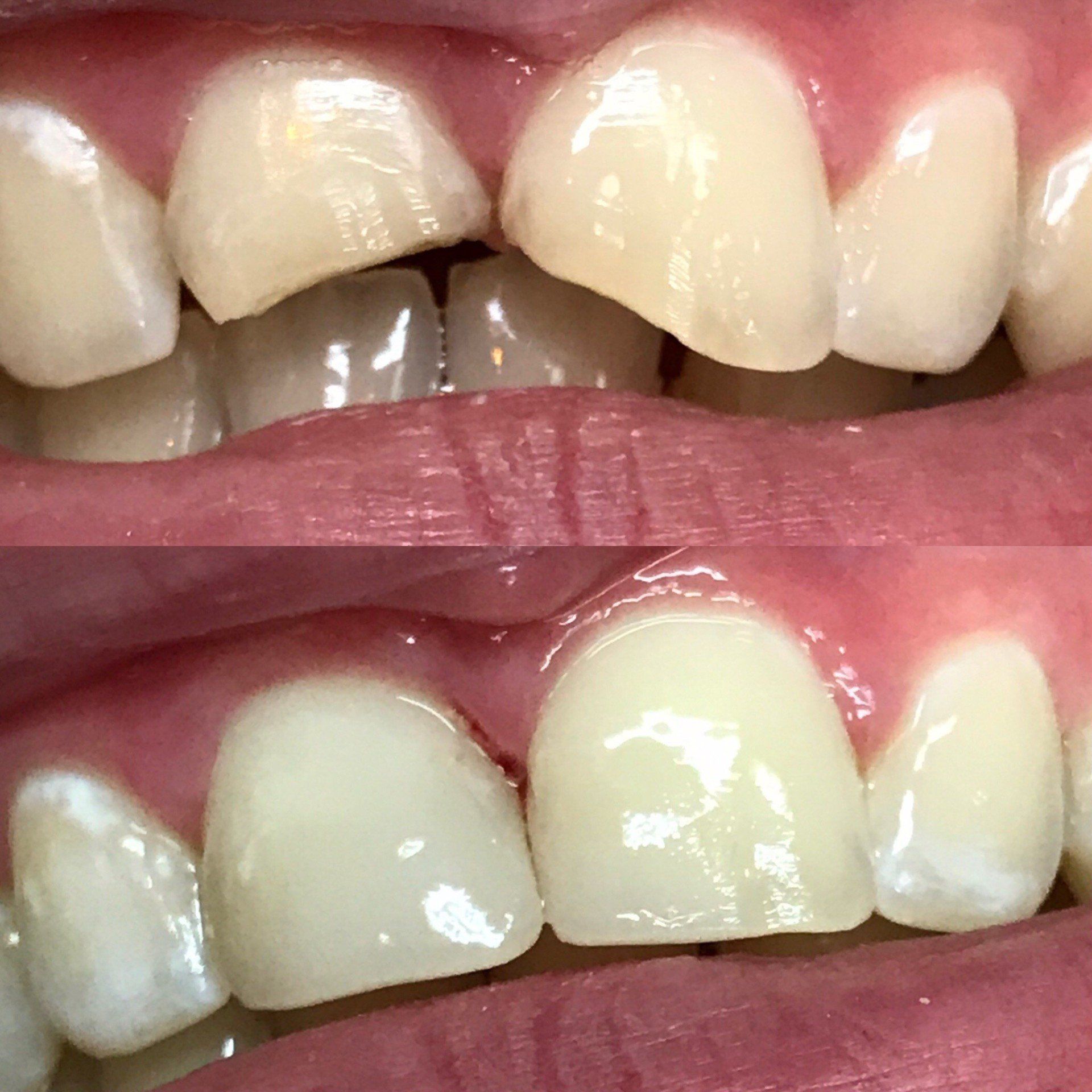 Bridges — Before and After of Dental Bonding in Clinton, MS