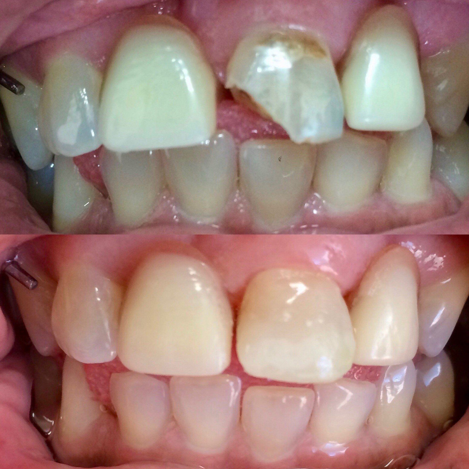 Crowns — Before and After of Teeth Bonding in Clinton, MS