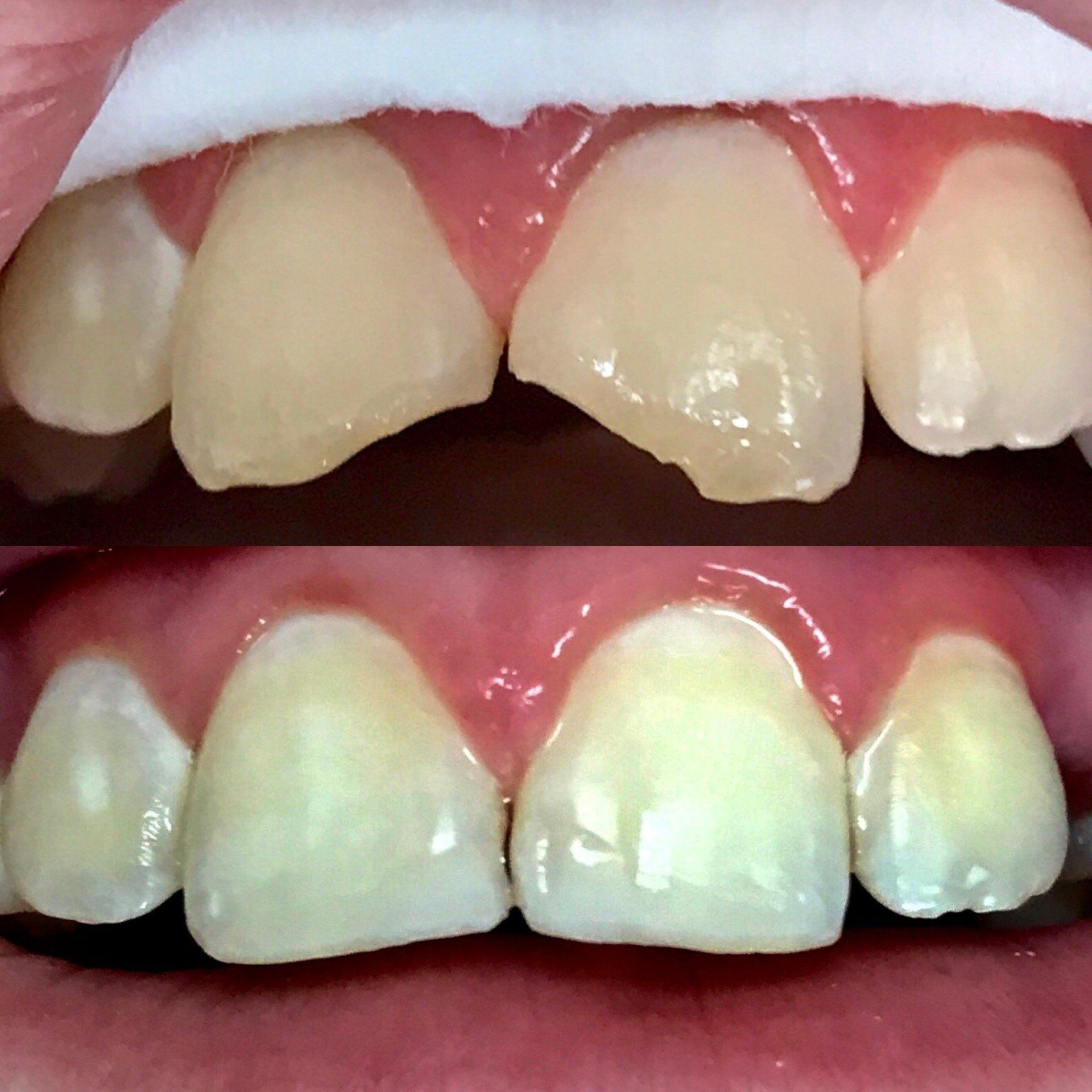 Dental Fillings — Before and After of Teeth Restoration in Clinton, MS