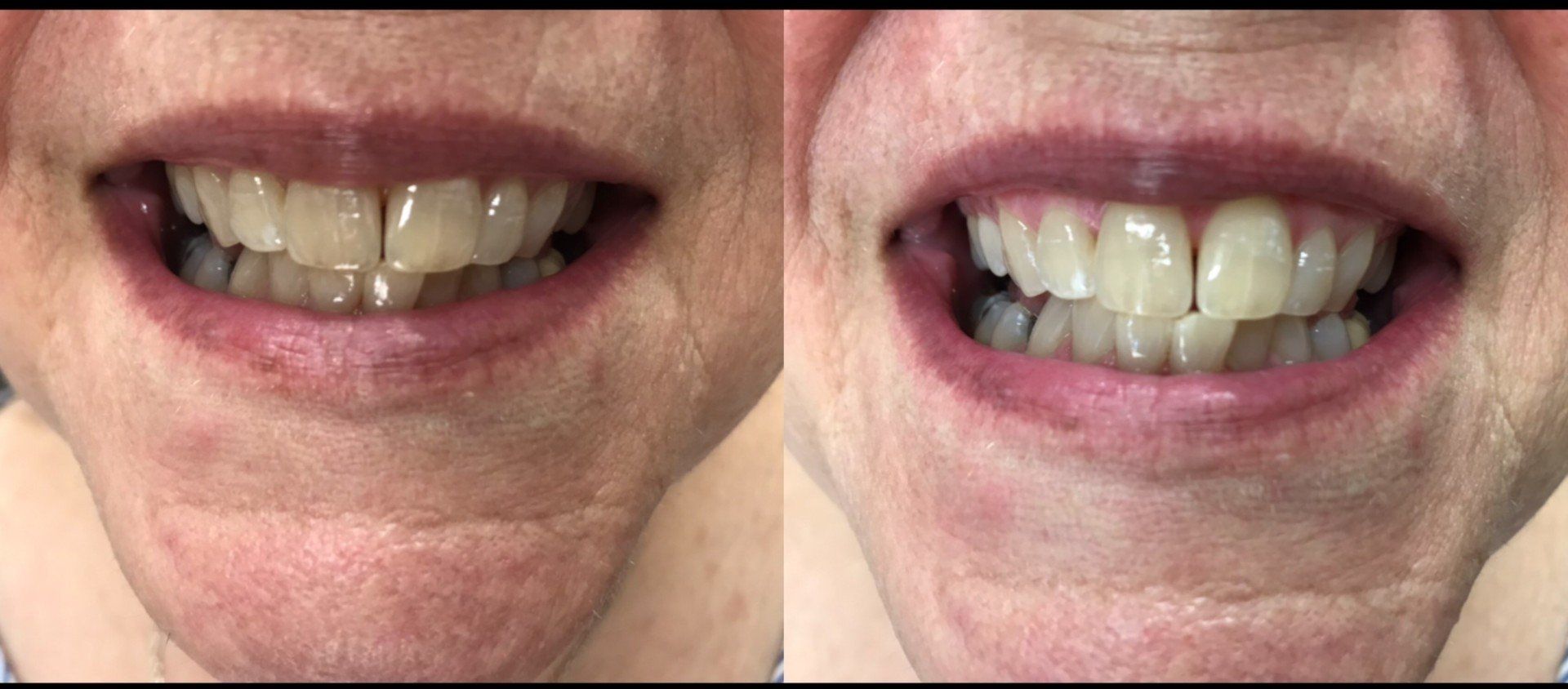 Root Canals — Tooth Whitening of Old Woman in Clinton, MS