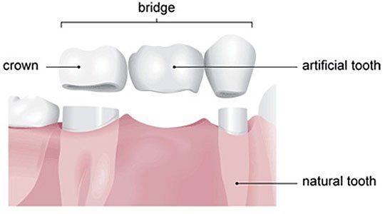 Dental Cleanings — Bridges Illustration in Clinton, MS