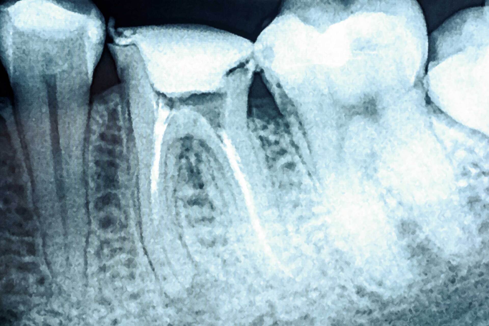 Una radiografía de los dientes de una persona que muestra un conducto radicular.