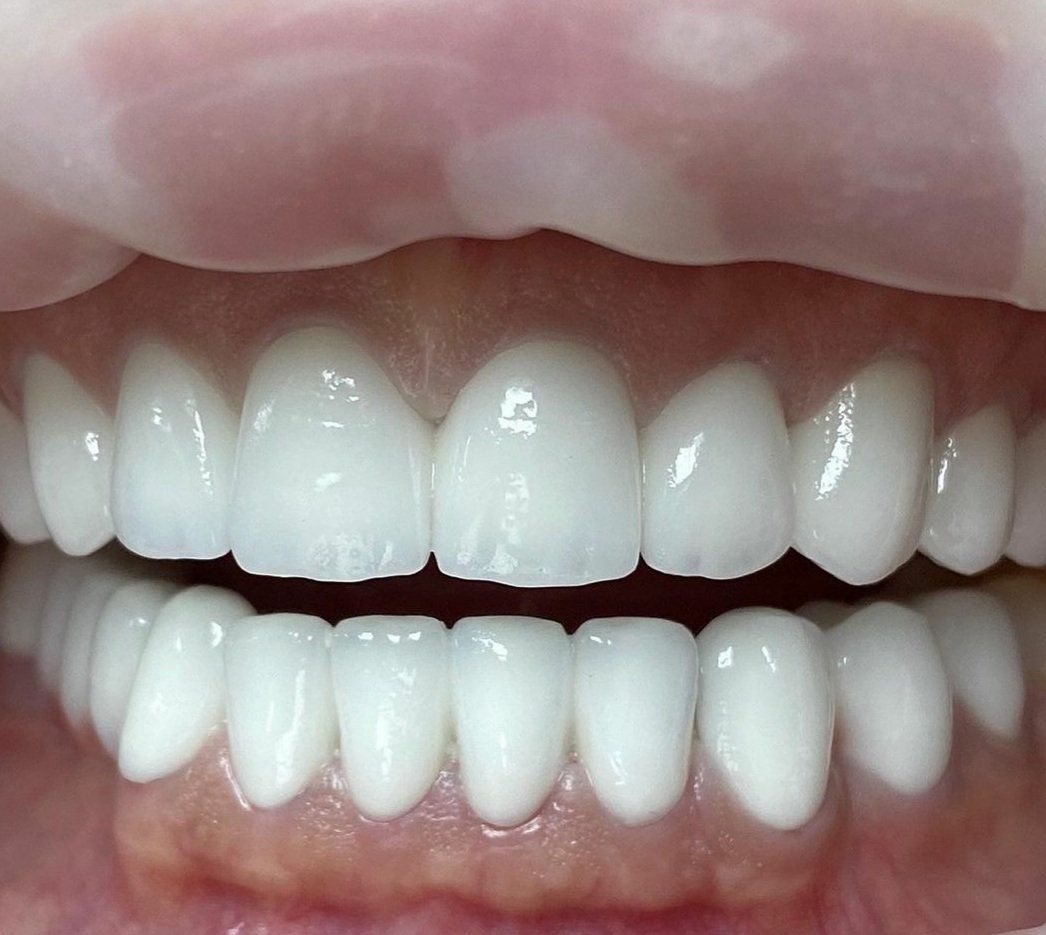 Un primer plano de los dientes de una persona con dientes blancos.