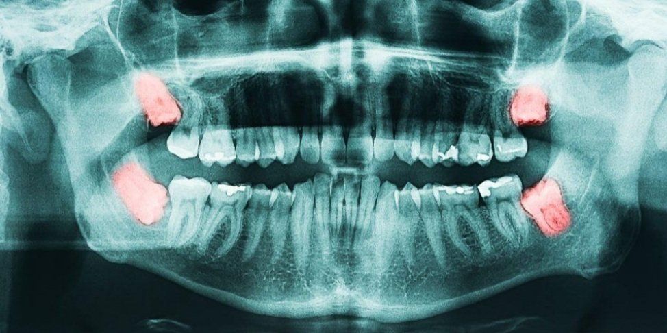Una radiografía de los dientes de una persona con dos muelas del juicio.