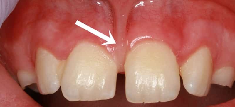 Un primer plano de los dientes de una persona con una flecha apuntando a las encías.