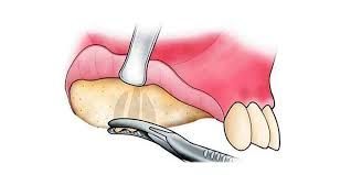 Un dibujo de un diente extraído con unas pinzas.