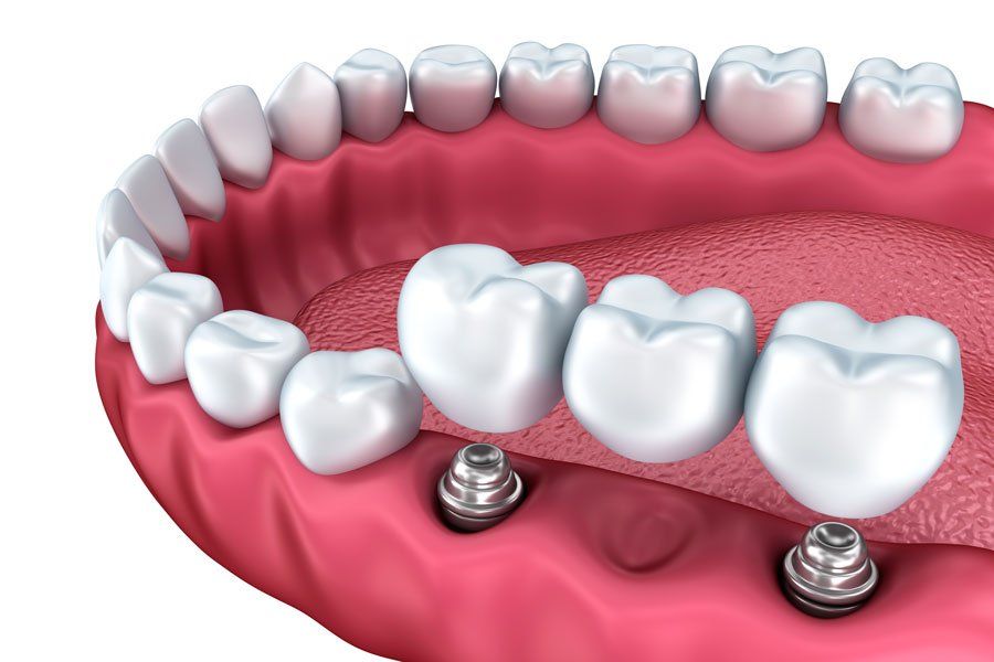 Un primer plano de los dientes de una persona con implantes dentales.