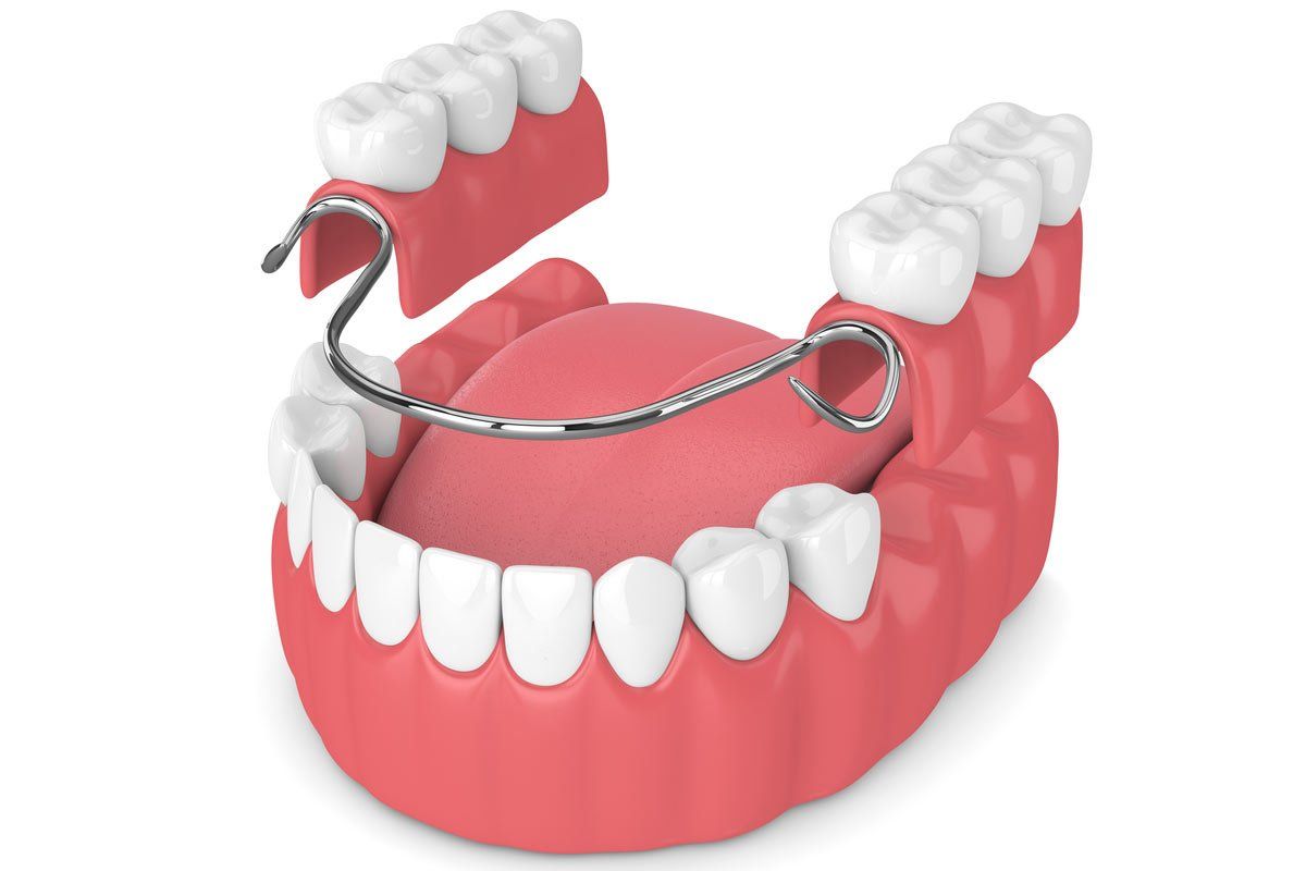 Un modelo de dentadura postiza con un aparato ortopédico de metal.