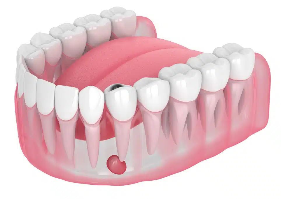 Un primer plano de un diente con un agujero.