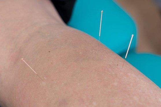 Three needles in a legs.