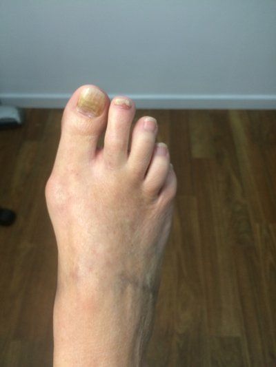 Fungal Nail Treatments