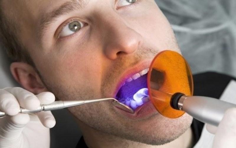 Sbiancamento denti con laser