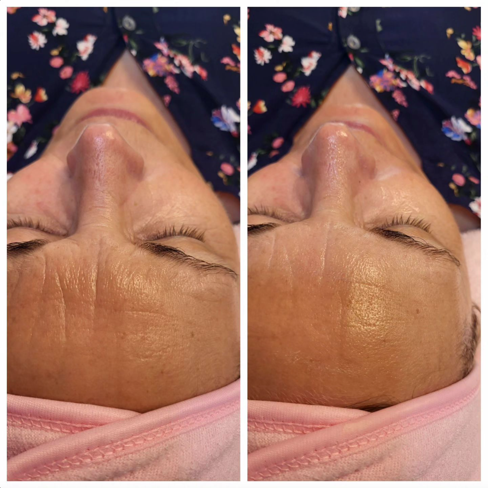 Ein Vorher-Nachher-Foto vom Gesicht einer Frau