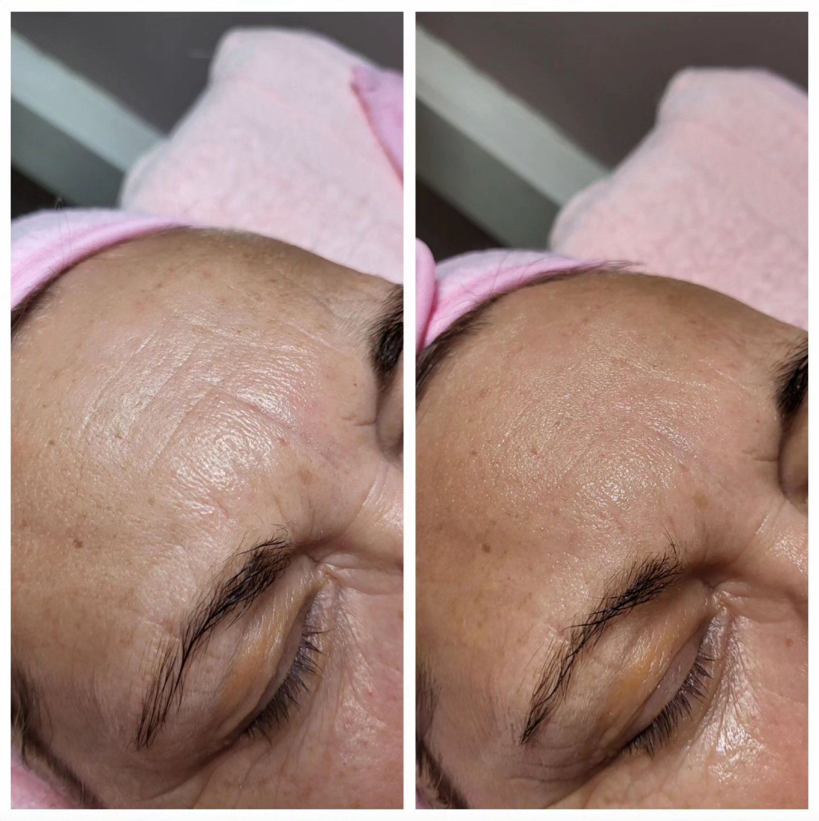 Das Gesicht einer Frau wird vor und nach einer Gesichtsbehandlung gezeigt.