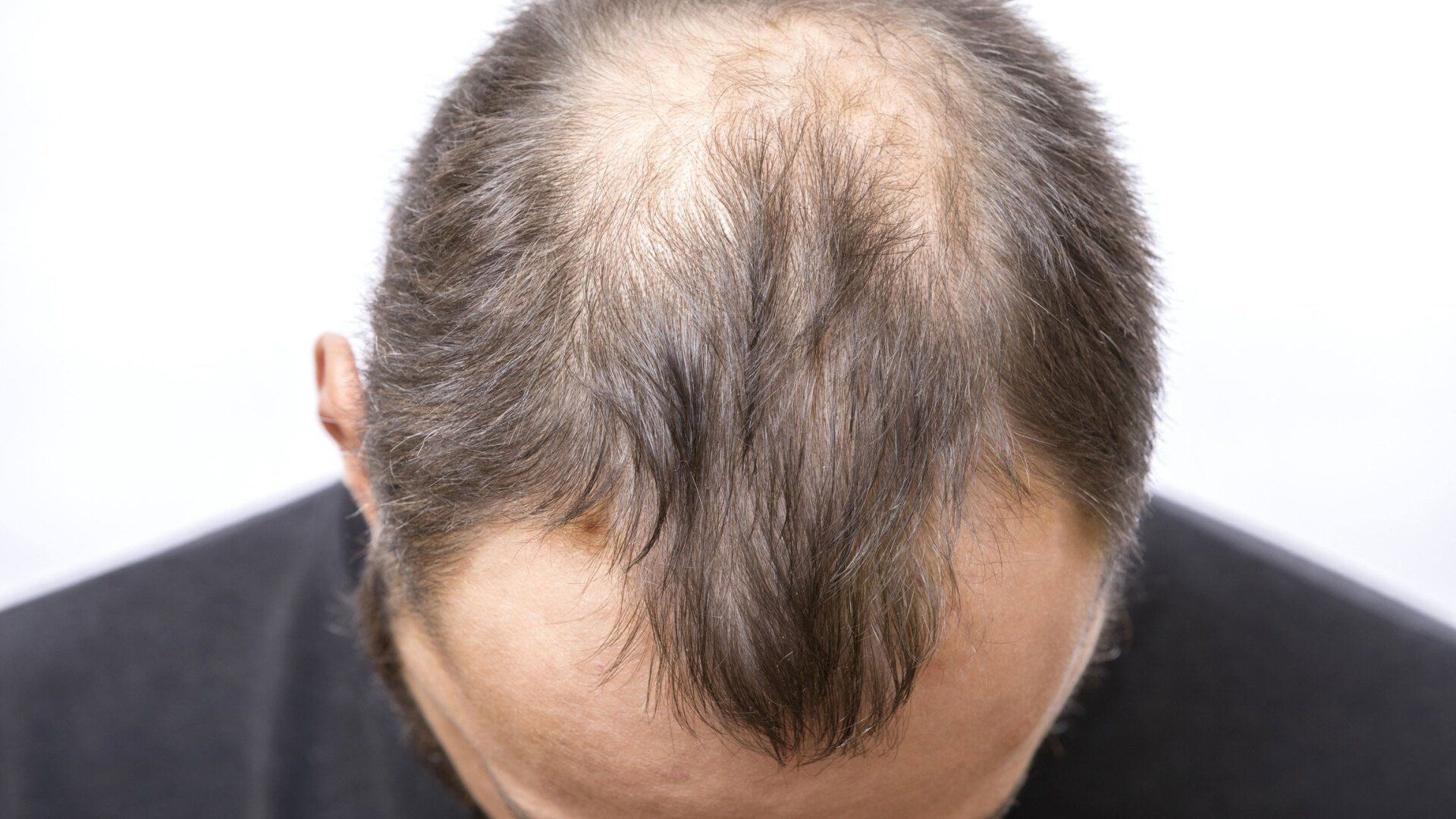 Robotic Hair Restoration — Fort Gratiot, MI — Hamzavi Dermatology & Dermatology Specialists