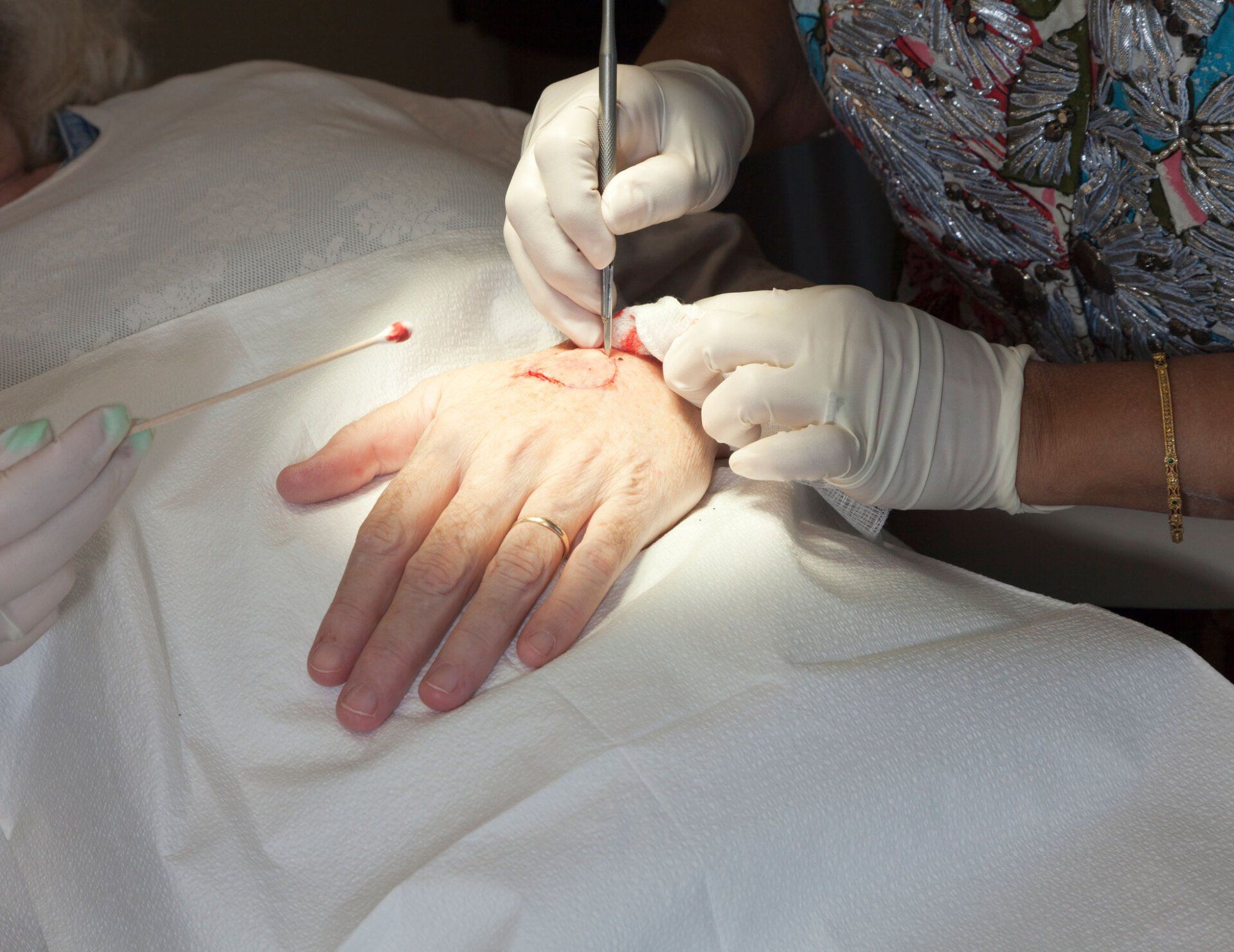 MOHS Micrographic Surgery — Fort Gratiot, MI — Hamzavi Dermatology & Dermatology Specialists