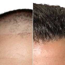 Before and After ARTAS — Fort Gratiot, MI — Hamzavi Dermatology & Dermatology Specialists
