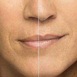 Before and After Belotero — Fort Gratiot, MI — Hamzavi Dermatology & Dermatology Specialists