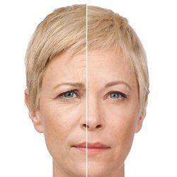 Before and After Botox — Fort Gratiot, MI — Hamzavi Dermatology & Dermatology Specialists