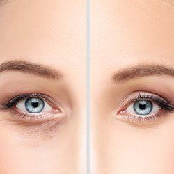Before and After Eyelid Lift — Fort Gratiot, MI — Hamzavi Dermatology & Dermatology Specialists