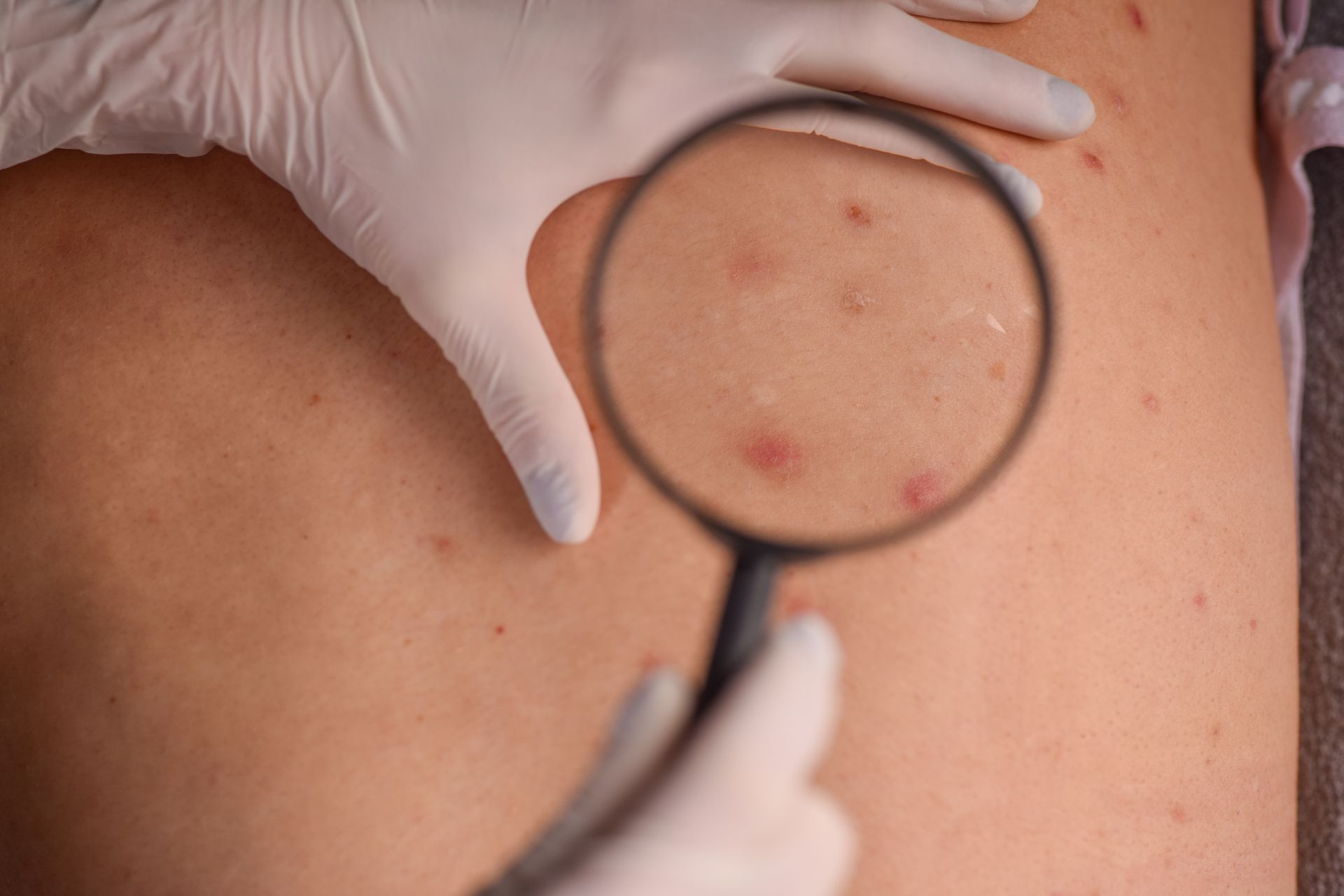 Gloved hands performing a skin exam on a patient using a magnifying glass to inspect red bumps.