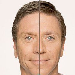 Before and After Radiesse — Fort Gratiot, MI — Hamzavi Dermatology & Dermatology Specialists