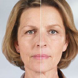 Before and After Sculptra — Fort Gratiot, MI — Hamzavi Dermatology & Dermatology Specialists