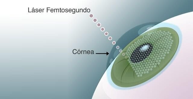OPTILÁSER - CATARATAS