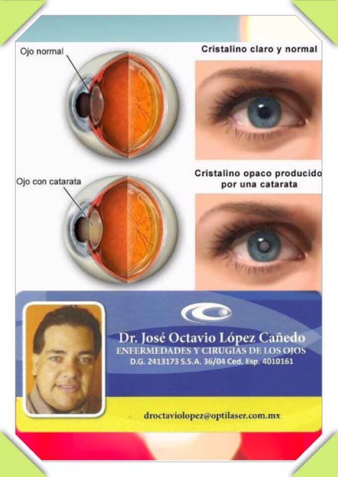 OPTILÁSER - Cataratas