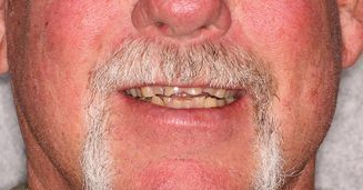 Close up of a man's smile before dental implants