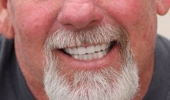 Close up of a man's smile after dental implants