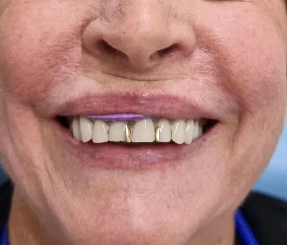 Smiling Person With Light Skin, Showing Teeth With Gold Adornments — Smiles on Hudson In Hamilton, NSW

