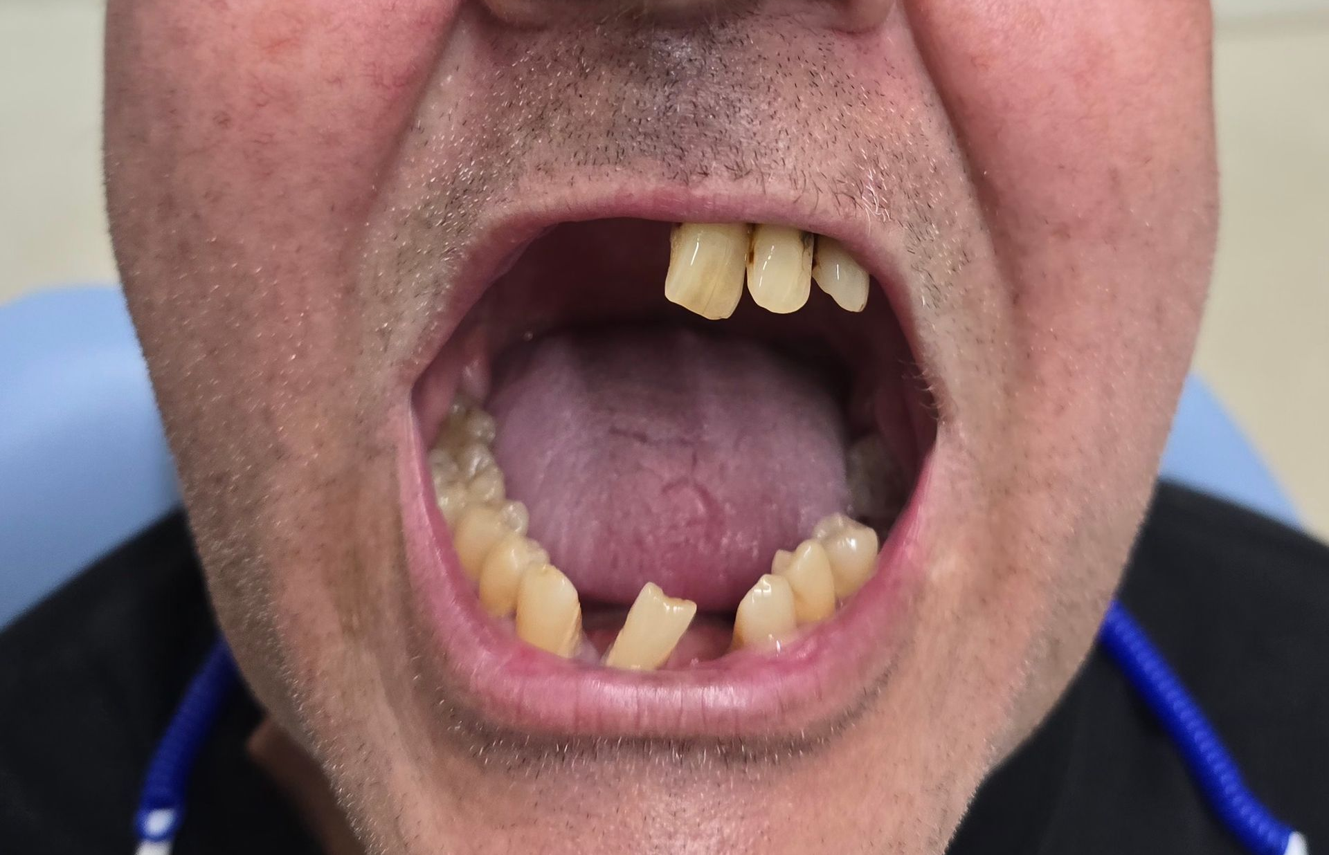Close-up of a Smiling Older Woman's Face Showing New, Straight Teeth — Smiles on Hudson In Hamilton, NSW
