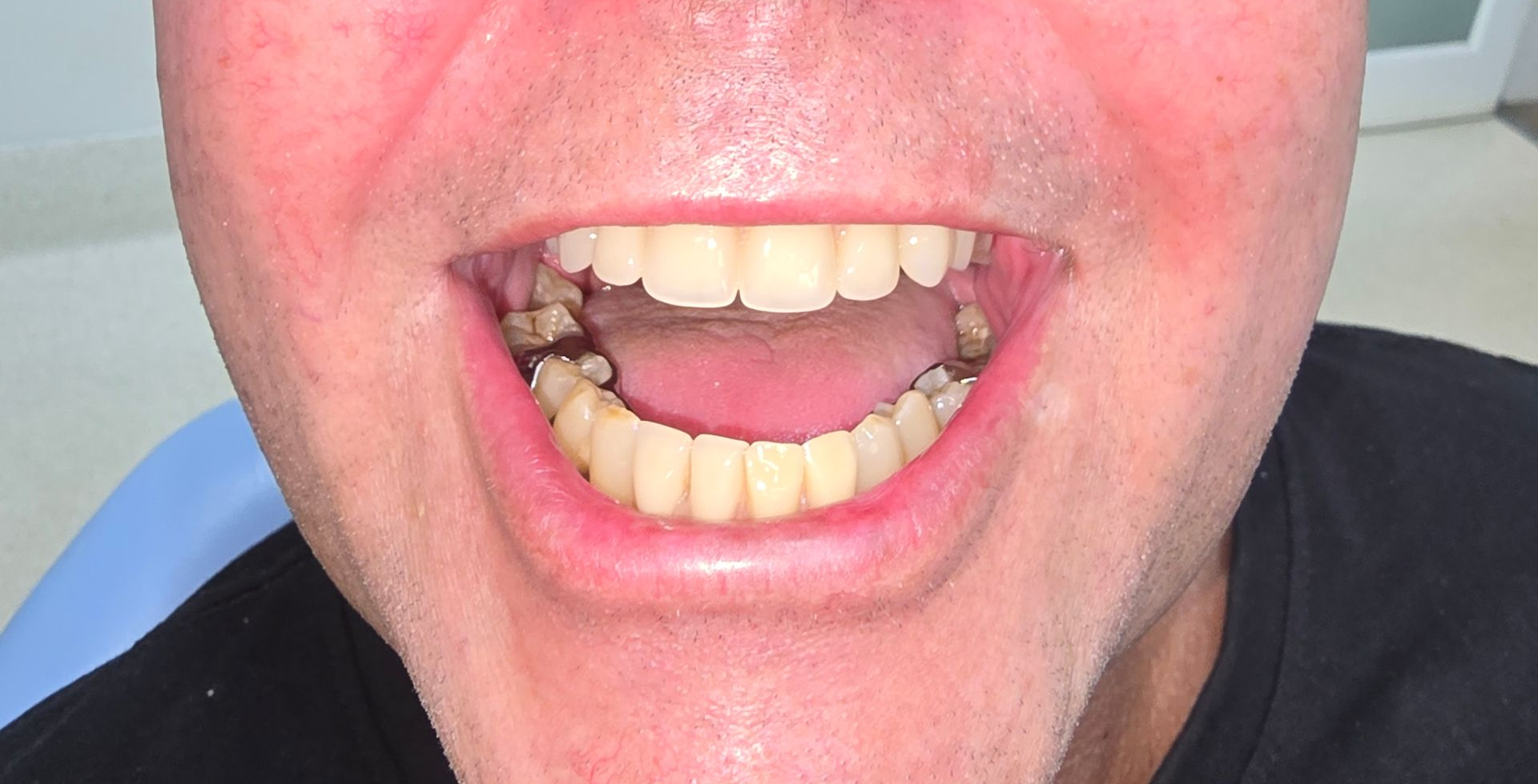 Smiling Older Woman With New, Bright White Teeth — Smiles on Hudson In Hamilton, NSW
