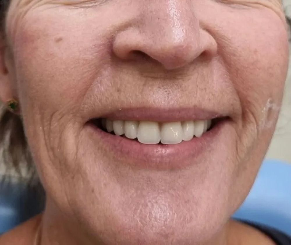 Close-up of a Smiling Woman Showing Her Teeth — Smiles on Hudson In Hamilton, NSW
