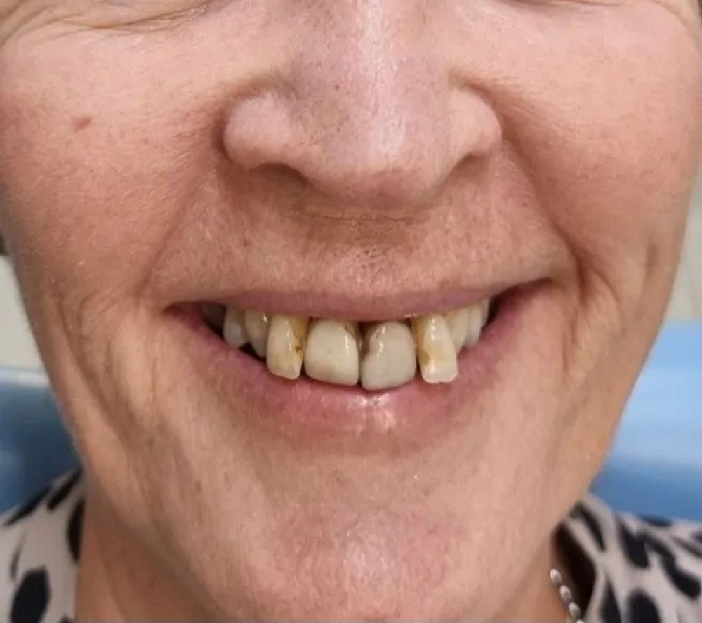 Woman Smiling, Showing Stained and Chipped Teeth — Smiles on Hudson In Hamilton, NSW
