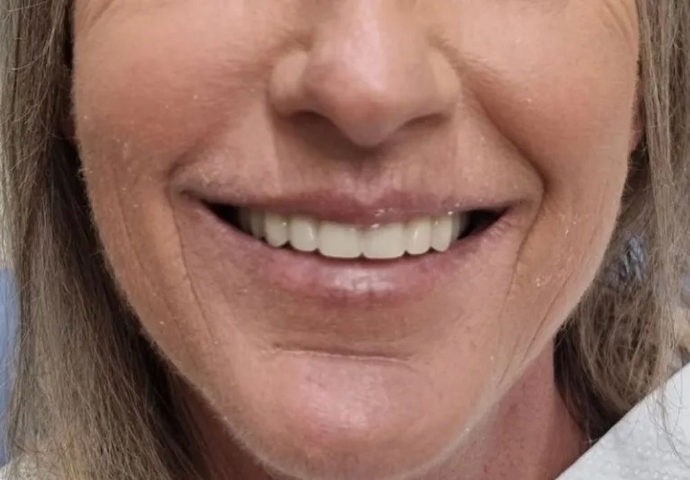 Woman Smiling, Showing Teeth, With Wrinkles Around the Mouth and Nose — Smiles on Hudson In Hamilton, NSW
