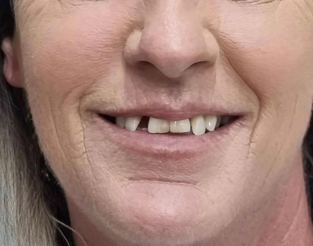 Woman Smiling, Missing a Front Tooth, With Visible Wrinkles — Smiles on Hudson In Hamilton, NSW
