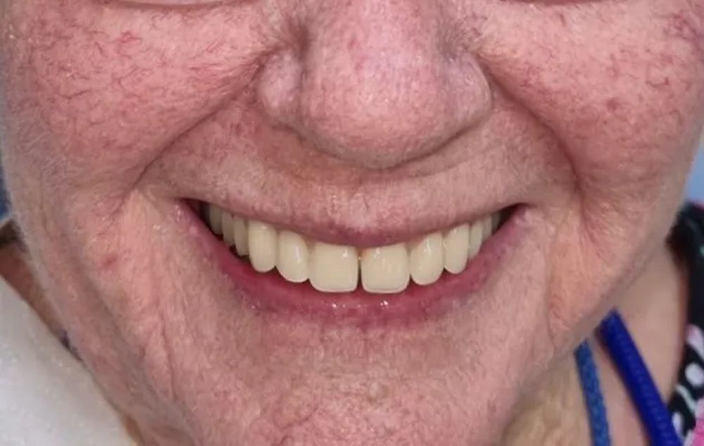 Close-up of an Older Person Smiling, Revealing a Set of White Teeth — Smiles on Hudson In Hamilton, NSW
