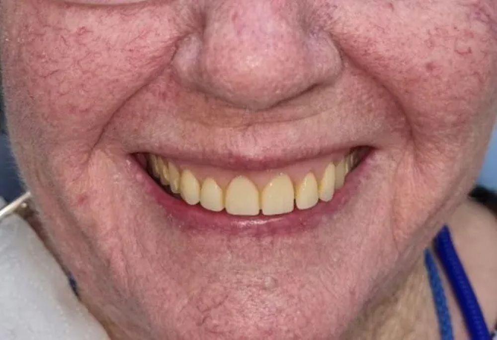 Close-up of an Older Person's Smiling Face, Showing Teeth and Reddish Skin — Smiles on Hudson In Hamilton, NSW
