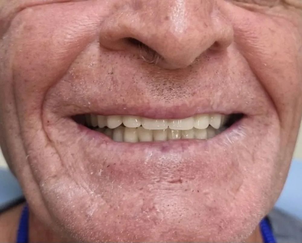 Close-up of a Smiling Older Man, Showing His Teeth — Smiles on Hudson In Hamilton, NSW
