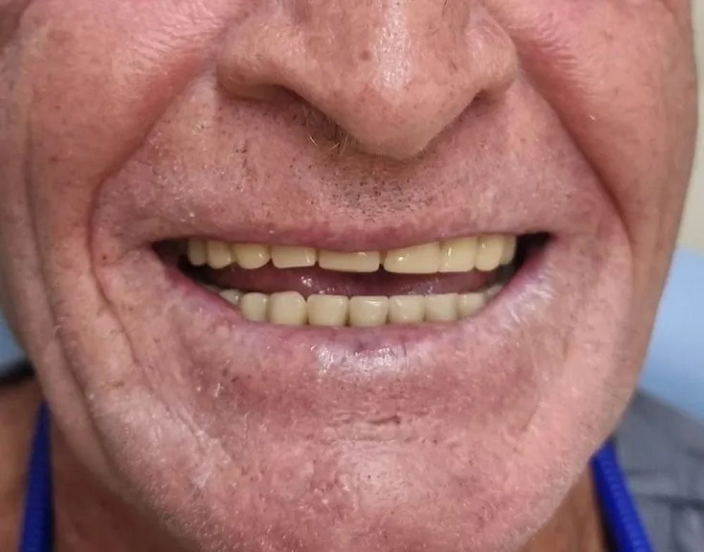 Close-up of a Smiling Man With Dentures — Smiles on Hudson In Hamilton, NSW
