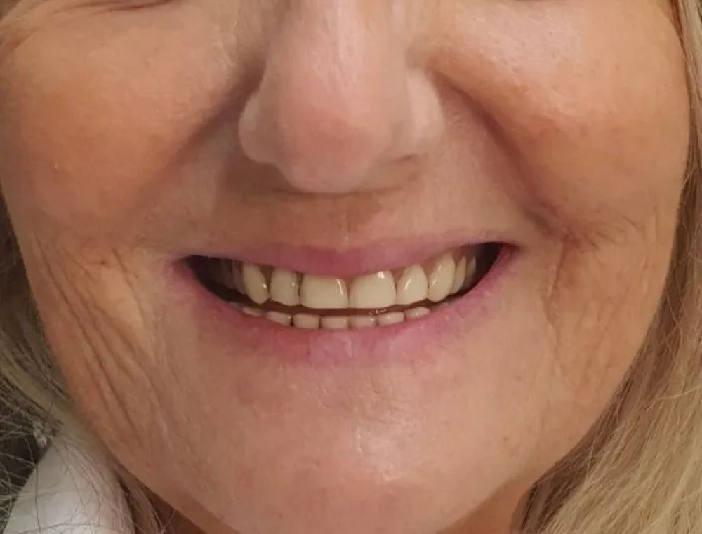 Close-up of a Smiling Older Woman's Face Showing New, Straight Teeth — Smiles on Hudson In Hamilton, NSW
