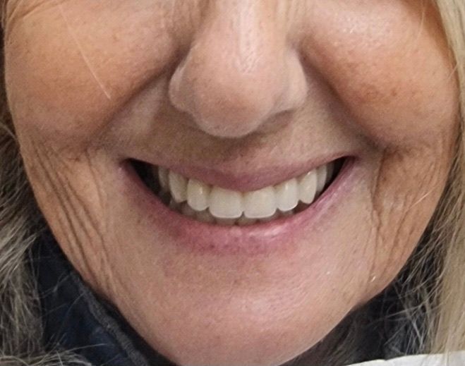 A lady with a smile and new teeth — Smiles on Hudson In Hamilton, NSW