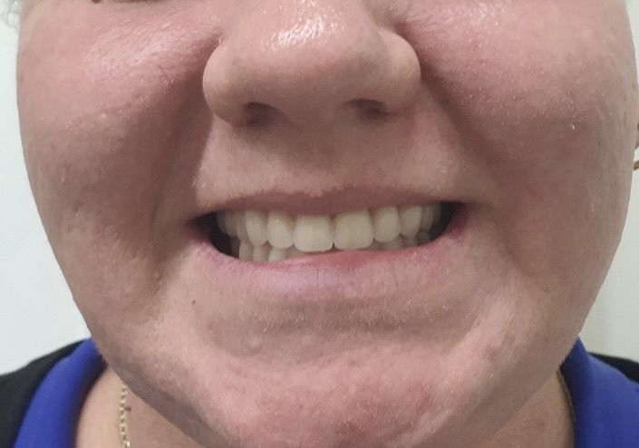 Smiling Older Woman With New, Bright White Teeth — Smiles on Hudson In Hamilton, NSW

